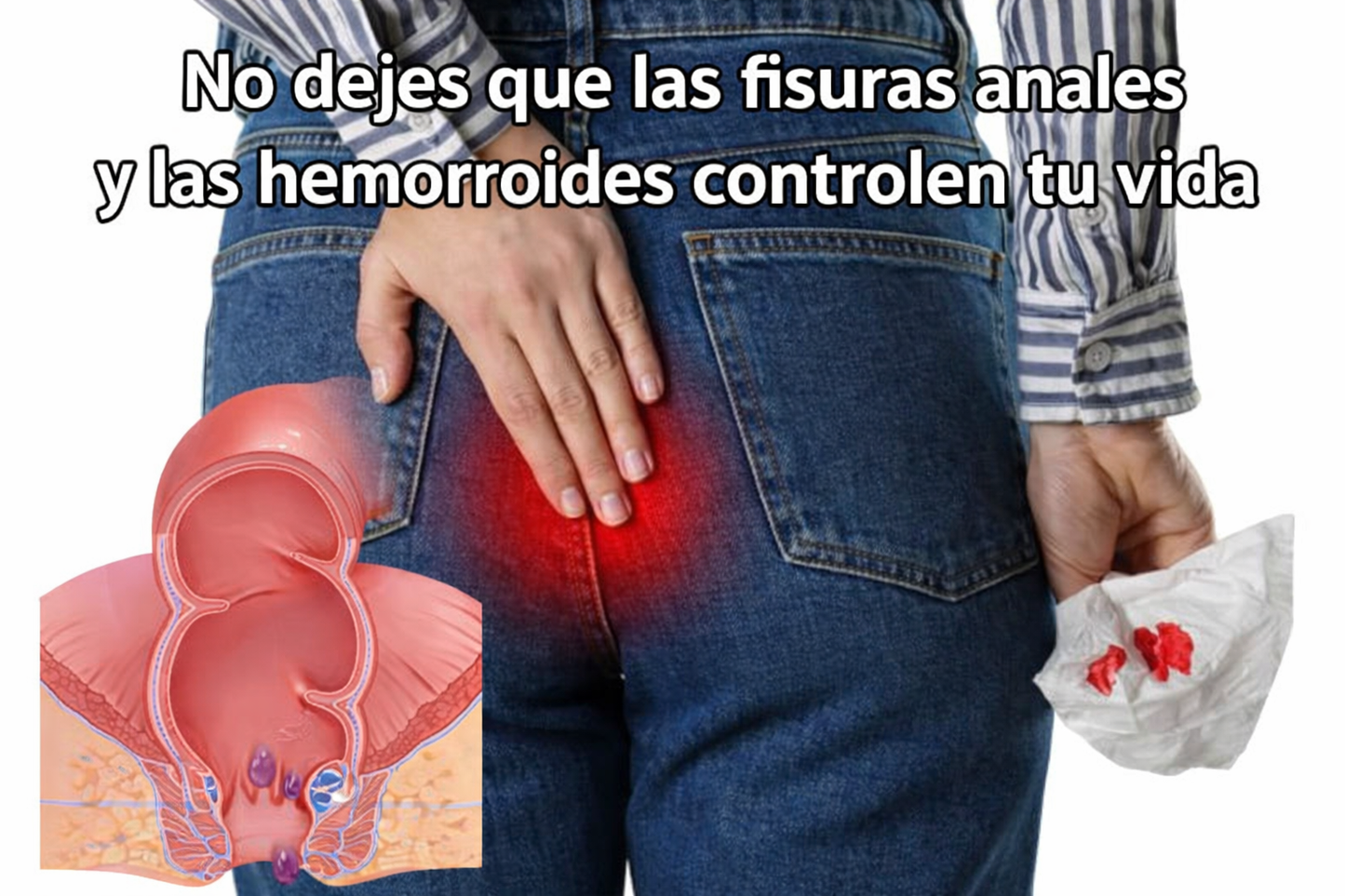 Crema HerbaPlus para Hemorroides®️